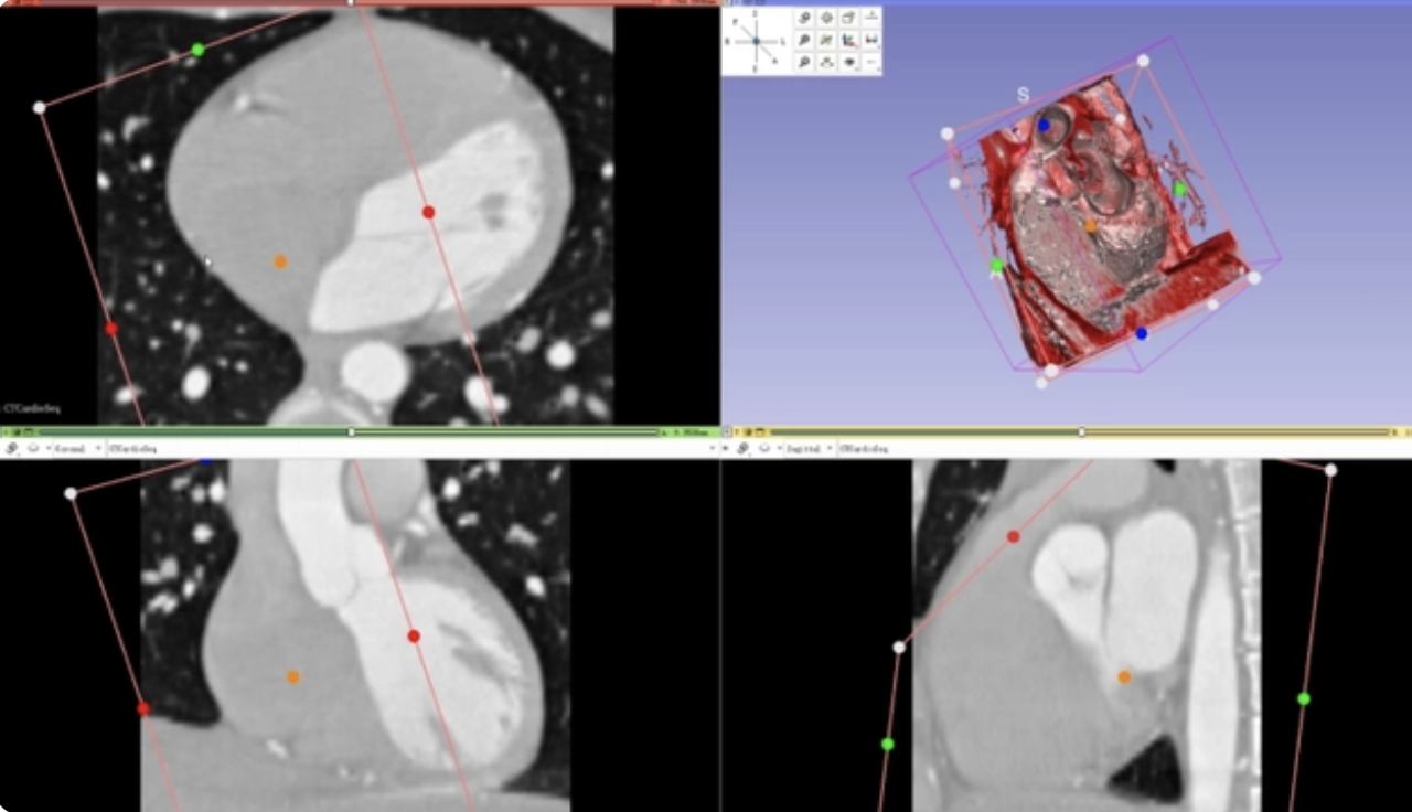 Up-close look at 'real' heart made by Chinese surgeon